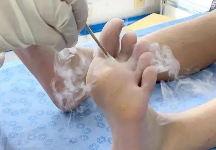 液氮治療 液氮治療